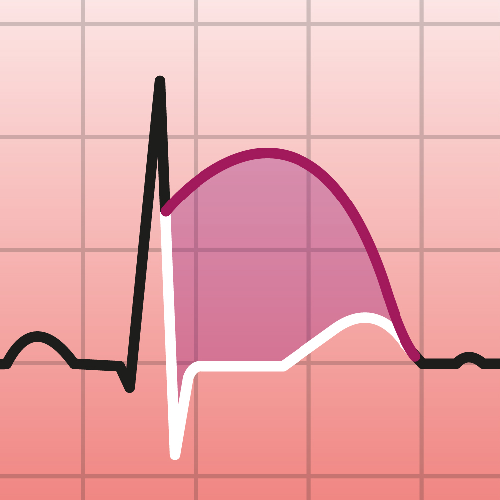 STEMI Einfach erkennen